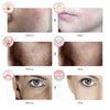7-Color Wireless LED Mask – Anti-Aging & Acne
